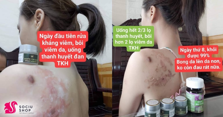 Có nên sử dụng kháng viêm Trần Kim Huyền trong giai đoạn mang thai và cho con bú không?
